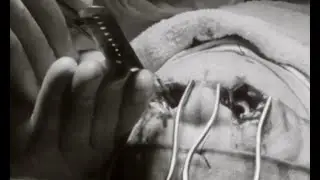Lobotomy 1950s TV special featuring Dr. Walter Freeman, plus electroshock therapy demonstration
