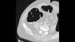 Polyp in the Right Colon