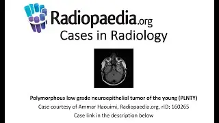 Polymorphous low grade neuroepithelial tumor of the young PLNTY (Radiopaedia.org) Cases in Radiology