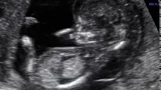 New UOG Journal ultrasound video clip on diagnosis of non‐immune hydrops