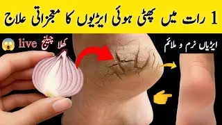 Guaranteed! Cure for Cracked Heels in 1 Night | Magic Remedy Makes Feet Soft & Smooth😱 Cracked Heels