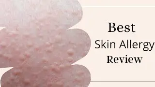 Patient Review @DTC skin clinic, Dr.Rohit Goel M.D. GIADA