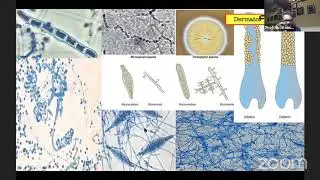 Management of Fungal Infections
