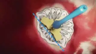 Transcatheter Mitral Valve Replacement (Neovasc)