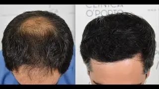 FUE Hair Transplant 4615 grafts Norwood IV Vertex, Dr Bruno Pinto, www Clinica OPorto.es
