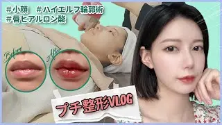 [プチ整形][皮膚科]切開なし！輪郭縮小？まゆが受けてみた！[VLOG]