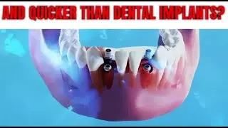 Fix Your Teeth Faster And Quicker Than Dental Implants