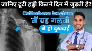 clavicle fracture healing timeline, collarbone fracture, tuti haddi kitne din mein jud jati hai