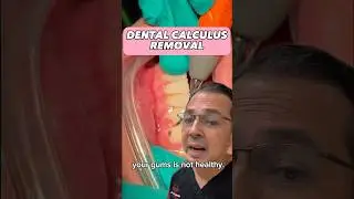 Удаление межзубного зубного камня с помощью ультразвукового скейлера | От очных занятий к практич...