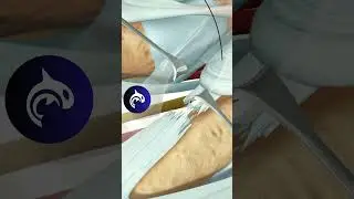 See how an Extensor Tendon Injury (Zone 4) is surgically repaired in 4K 3D animation.