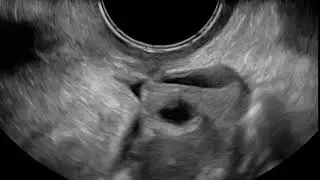 Video 10: Small uterosacral ligaments in deep endometriosis in ovarian endometrioma