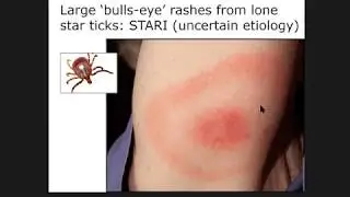 14 Years of Wildlife/Tick Research in Eastern Tennessee