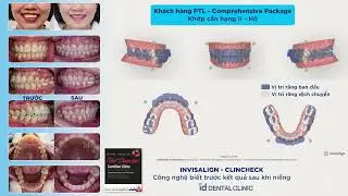 Răng H&ocirc; - Khớp cắn hạng II | Invisalign ClinCheck id Dental Clinic