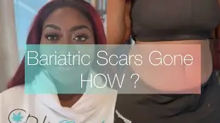 How to MINIMIZE the  DARKNESS of your scars post  Weightloss Surgery | 3 Affordable Products