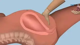 MANUAL PLACENTA REMOVAL