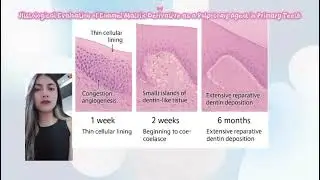 Summary of Histological Evaluation of Enamel Matrix Derivative as a Pulpotomy Agent in Primary Teeth