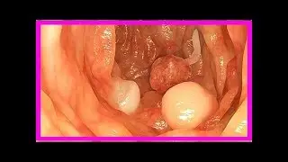 Welche Art von Darmpolyposis kann Krebs sein?