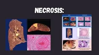 Necrosis & Its Types | Coagulative, Liquefactive, Caseous, Fibrinoid, Gangrene (Easy Explanation)