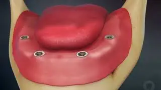 All on Four implants | DENTAL IMPLANTS | DENVAK