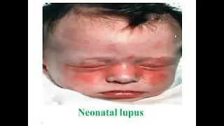 Rheumatic Diseases of Childhood (Cases Part 1)