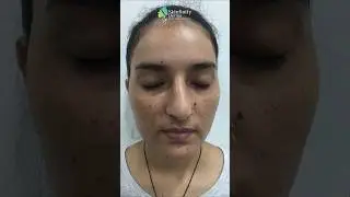 ✨ Freckles Before & After Transformation | Real Skin Results! 🌟