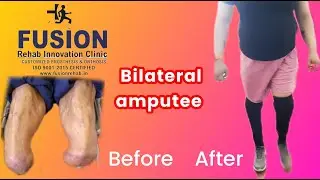Bilateral below knee prosthesis 88267 12631, 97117 49392 @fusionrehab