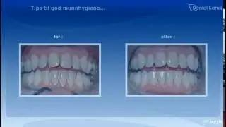 Tips til god munnhygiene