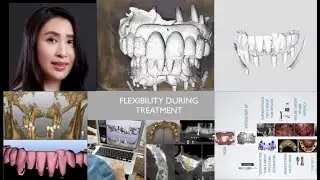 Digital Full Mouth Implant Rehabilitation