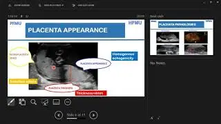 Ultrasound Assesment of Placenta