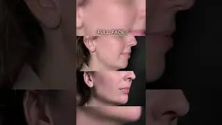 Full Face &mdash; современный подход к гармонизации лица #fullface #контурнаяпластика #гармонизациялица