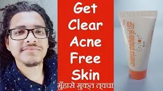 मुहाँसों (पिम्पल्स ) से छुटकारा | How to use Erytop Gel | Pimples Removal Cream | Hindi/Urdu