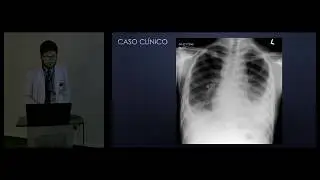 Tuberculosis Pulmonar.- Dr. Edgar Hernández