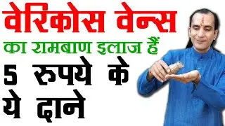 वैरिकोस वेन्स के घरेलू नुस्खे, पैर की नीली नसों का इलाज, Varicose Veins Ka ilaj, Cure Varicose Veins