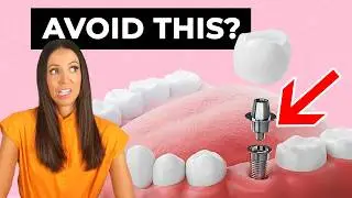Should You Avoid Dental Implants?