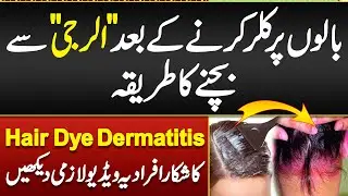 Hair Color Sy Allergy Ka ilaj- Hair Dye Dermatitis- Hair Dye Reactions- Hair Color Allergy Treatment