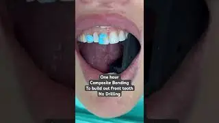 Build out front tooth ...No drilling ...Composite bonding in one hour