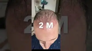 Hair Transplant DHI - 6 Months in 60 SECONDS! #greffedecheveux #hairtransplant  #timelapse #shorts