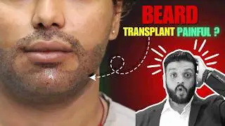 Is Beard Transplant Painful During & After the Procedure? Best Clinic For Beard Transplant in India