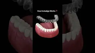 #invisalign#invisalignsmile#braces#invisaligndoctor#invisalignteen#orthodontics#invisalignprovider