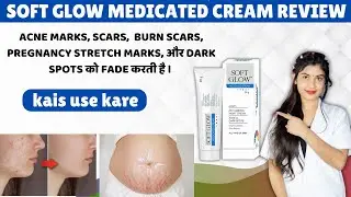 Is Soft Glow Cream Good? | Best Cream for Acne Marks and Scars | How to Use | Price ✅