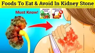 What should one eat to avoid kidney stones? Foods to Eat & Avoid in Kidney Stone