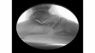 Talotarsal Displacement Fluoroscopy