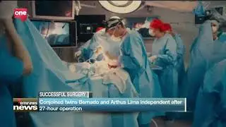 Brazilian twins have been successfully separated