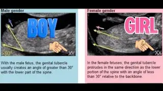 Baby Gender Prediction: Is The 
