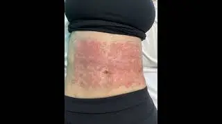 NON-surgical Ab tightening
