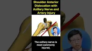 Shoulder Dislocation Axillary with Nerve and Artery injury