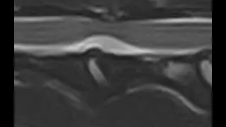 Thoracolumbar hydrated nucleus pulposus extrusion - clinical characteristics and MRI findings
