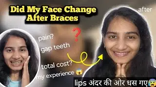 Face me changes after Braces removal: sahi ya chehra kharab?😨 || Braces transformation 