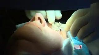 New technique to eliminate reading glasses