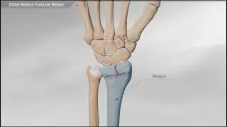 Distal Radius Fracture Repair